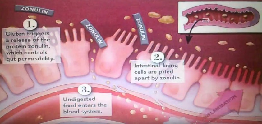 Intestino permeabilizado pelo glúten
